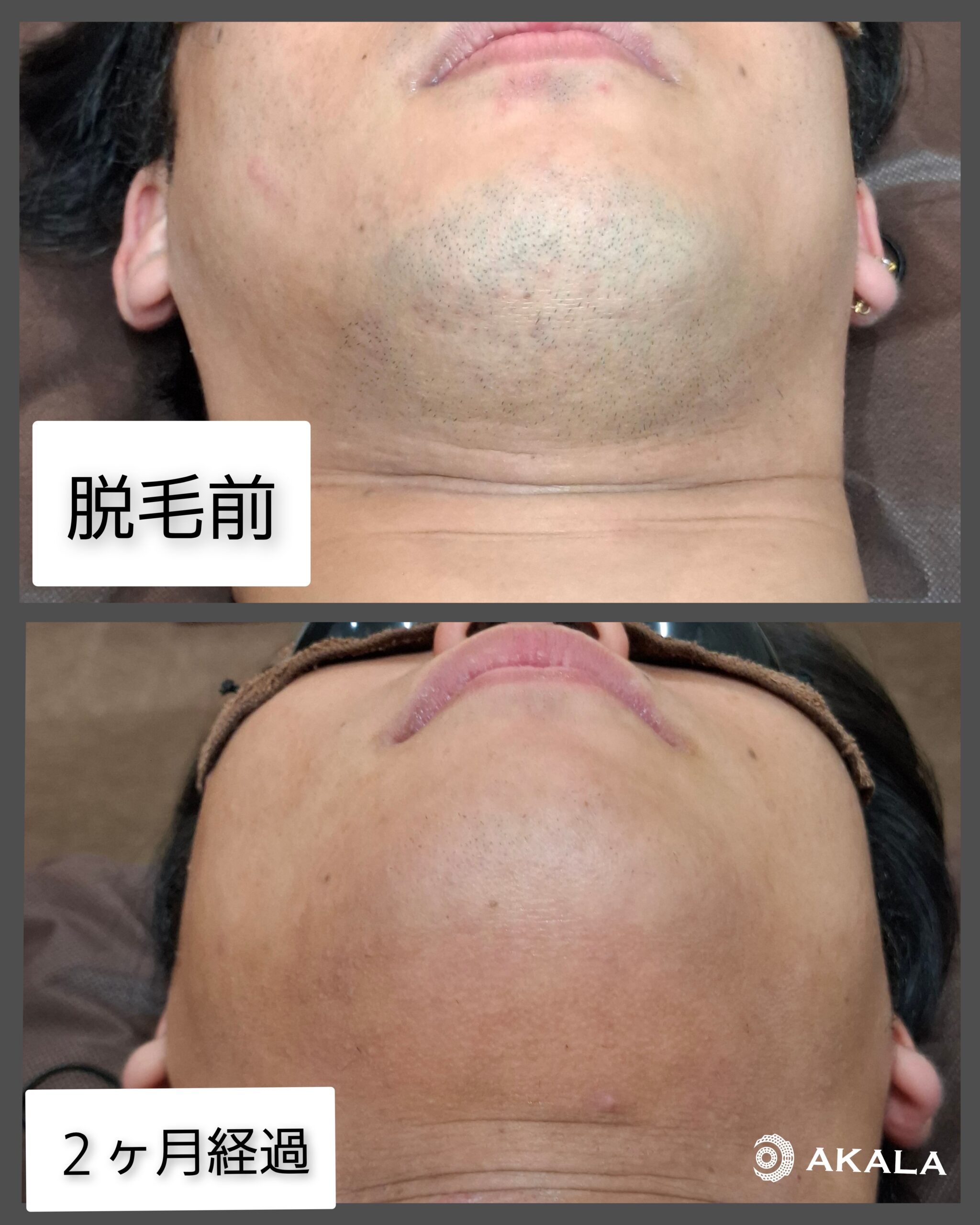 2ヶ月経過～ - AKALA（美里店）