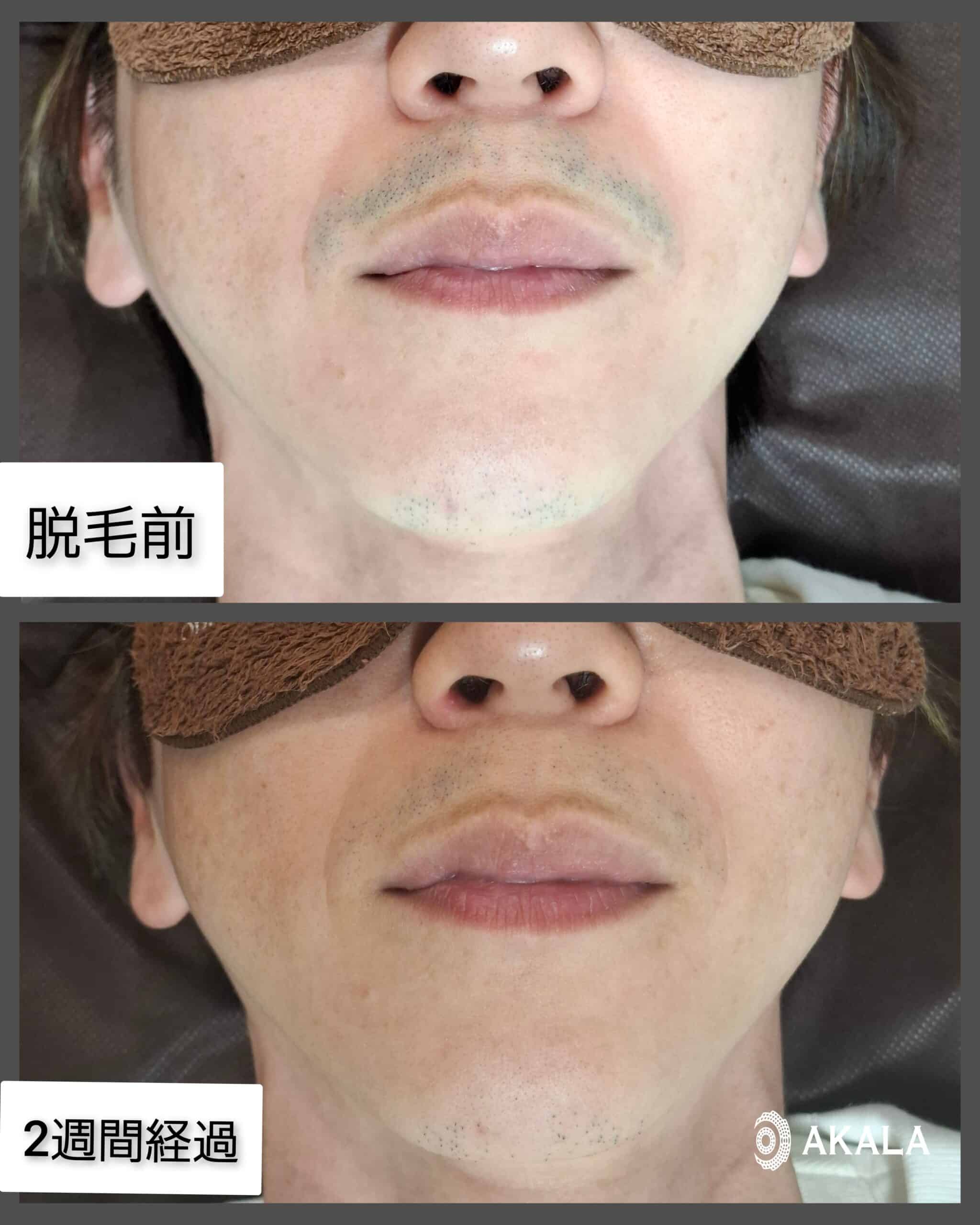 ヒゲ脱毛の効果を2週間で実感！AKALA美里店