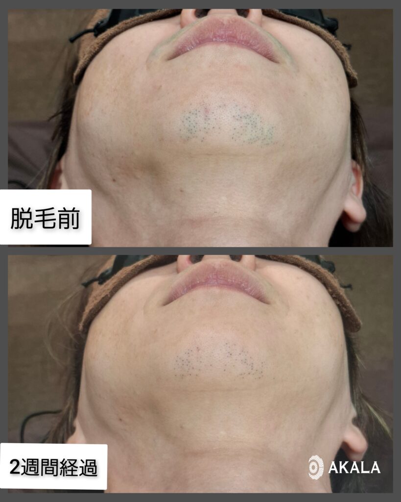 2週間のヒゲ脱毛の効果