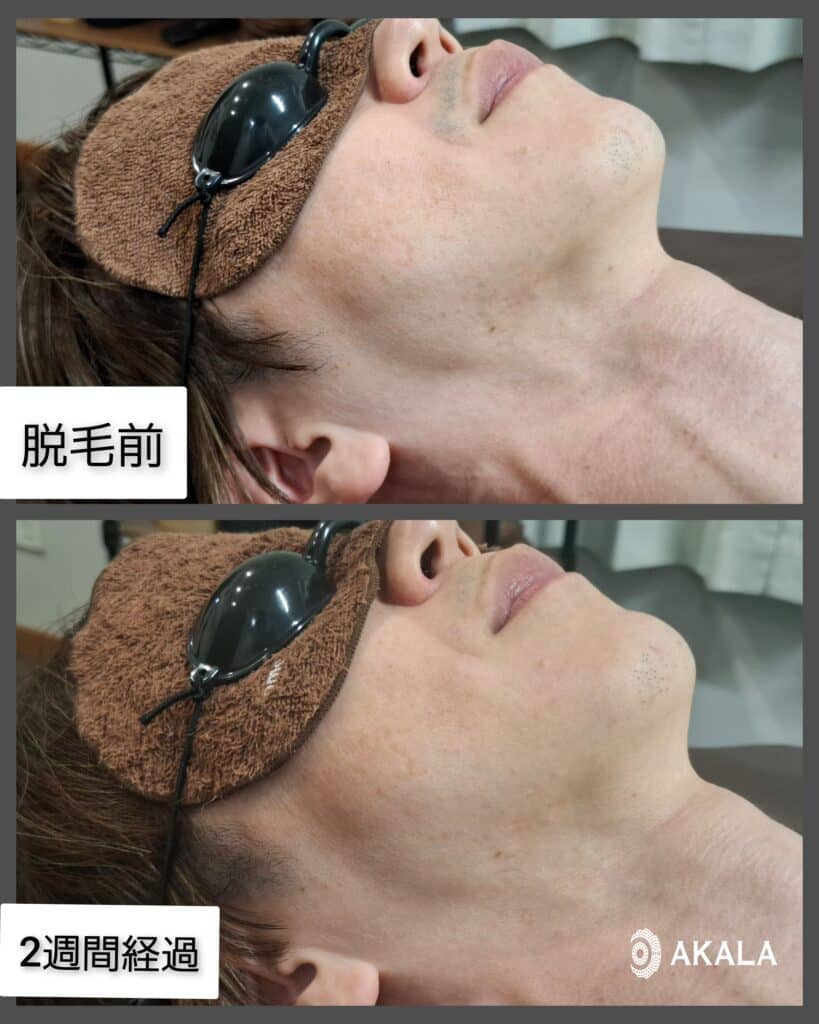 2週間のヒゲ脱毛の効果